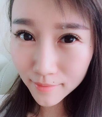 曾经双眼皮手术失败的她，在重庆超雅修复好了！107