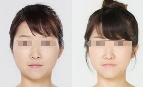 重庆超雅超声波瘦脸需要注意什么呢?602 重庆超雅超声波瘦脸需要注意什么呢?602