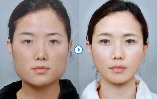 重庆超雅超声波瘦脸需要注意什么呢?602 重庆超雅超声波瘦脸需要注意什么呢?602