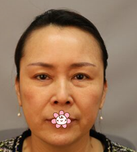 重庆超雅面部提升术让你定格住青春657 重庆超雅面部提升术让你定格住青春657