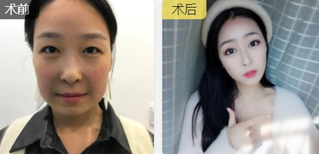 重庆超雅面部提升术让私企老板蜕变小清新少女