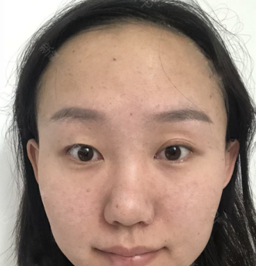 重庆超雅超声波双眼皮手术看着还不错的550 重庆超雅超声波双眼皮手术看着还不错的550