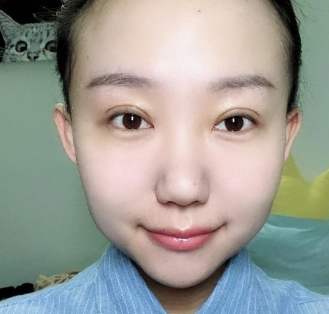 重庆超雅超声波双眼皮手术看着还不错的550 重庆超雅超声波双眼皮手术看着还不错的550