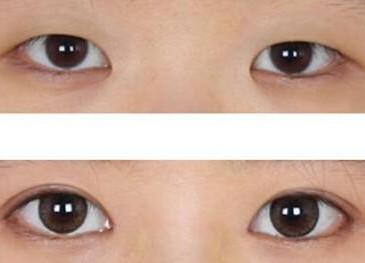 在重庆超雅做到自己喜欢的超声波双眼皮手术616 在重庆超雅做到自己喜欢的超声波双眼皮手术616