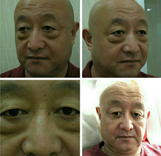 大事件→陈寒柏又来重庆超雅北京分店做面部提升术啦 大事件→陈寒柏又来重庆超雅北京分店做面部提升术啦