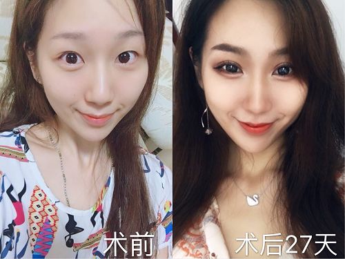 想整形而不被发现,重庆超雅满足你849 想整形而不被发现,重庆超雅满足你849