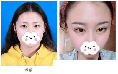 想整形而不被发现,重庆超雅满足你849 想整形而不被发现,重庆超雅满足你849