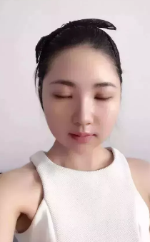2018年度重庆超雅双眼皮手术案例大赏，你来评判！748