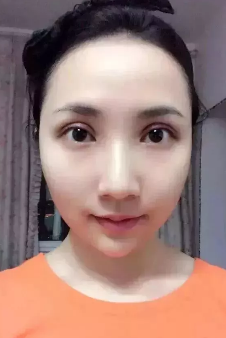 2018年度重庆超雅双眼皮手术案例大赏，你来评判！748