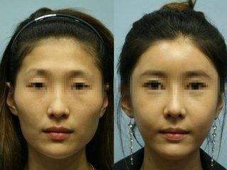 重庆超雅自体脂肪填充术→你的美丽套装之一917 重庆超雅自体脂肪填充术→你的美丽套装之一917
