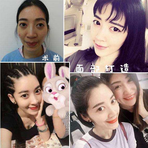 重庆超雅自体脂肪填充术→你的美丽套装之一917 重庆超雅自体脂肪填充术→你的美丽套装之一917