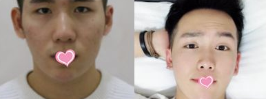 重庆超雅自体脂肪填充术→你的美丽套装之一917 重庆超雅自体脂肪填充术→你的美丽套装之一917