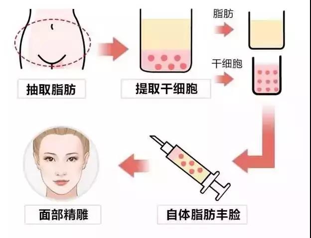 重庆超雅自体脂肪填充术→你的美丽套装之一917 重庆超雅自体脂肪填充术→你的美丽套装之一917