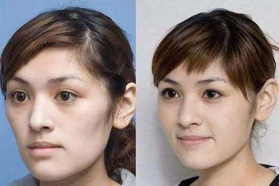 重庆超雅自体脂肪填充术→你的美丽套装之一917 重庆超雅自体脂肪填充术→你的美丽套装之一917