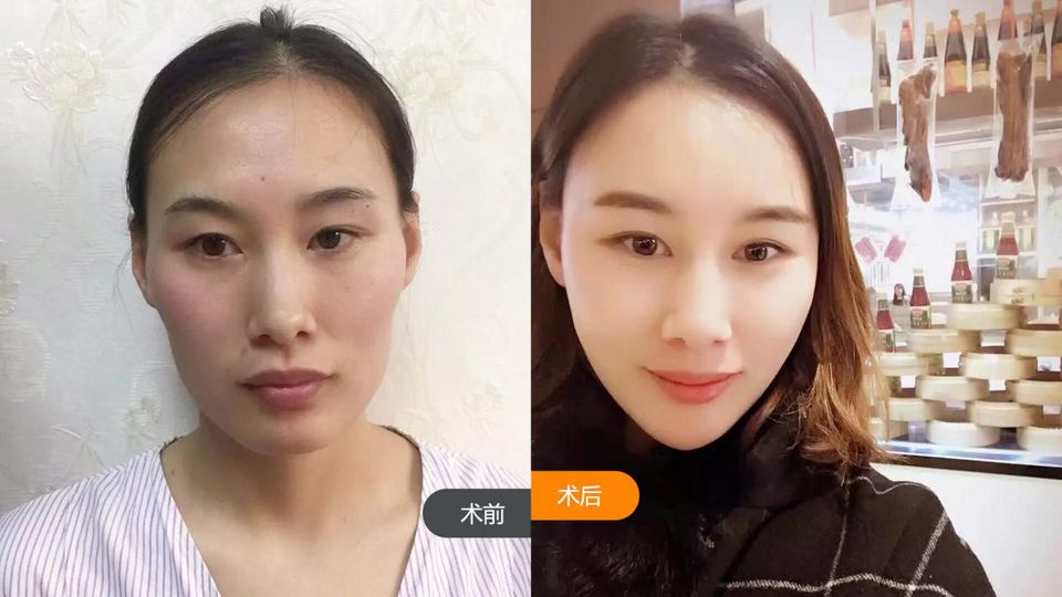 重庆超雅自体脂肪填充术→你的美丽套装之一917 重庆超雅自体脂肪填充术→你的美丽套装之一917