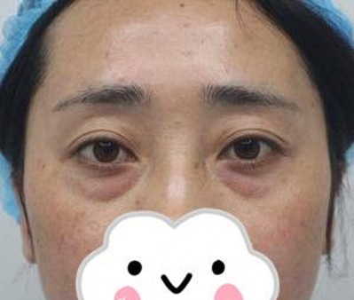 超声波去眼袋,顺利的去除了大眼袋