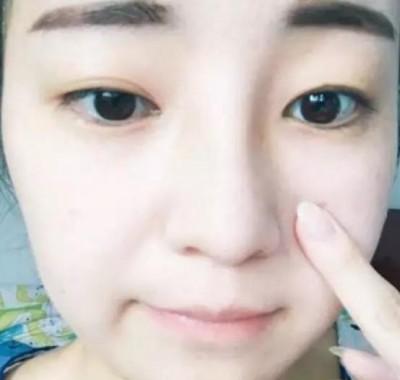 超声波双眼皮,让我的颜值提升了一大截655 超声波双眼皮,让我的颜值提升了一大截655