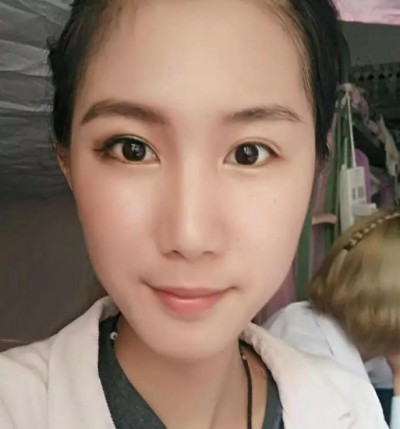 超声波双眼皮,让我的颜值提升了一大截655 超声波双眼皮,让我的颜值提升了一大截655