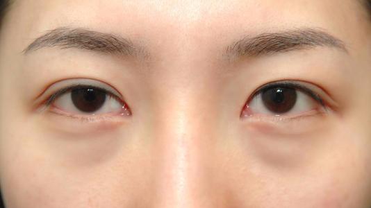 妈妈依靠超 声 波去眼袋去掉多年得眼袋 妈妈依靠超 声 波去眼袋去掉多年得眼袋