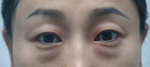 妈妈依靠超 声 波去眼袋去掉多年得眼袋 妈妈依靠超 声 波去眼袋去掉多年得眼袋
