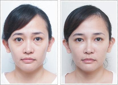 妈妈依靠超 声 波去眼袋去掉多年得眼袋 妈妈依靠超 声 波去眼袋去掉多年得眼袋