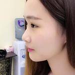 爱美的我做了超声波双眼皮163 爱美的我做了超声波双眼皮163