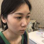 双眼皮一步到位,以后不再烦恼241 双眼皮一步到位,以后不再烦恼241