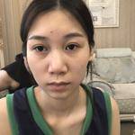 双眼皮一步到位,以后不再烦恼241 双眼皮一步到位,以后不再烦恼241
