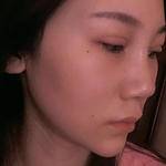 双眼皮一步到位,以后不再烦恼241 双眼皮一步到位,以后不再烦恼241