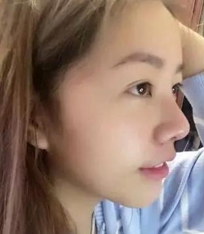 超声波去眼袋,去掉眼袋让我心花怒放465 超声波去眼袋,去掉眼袋让我心花怒放465