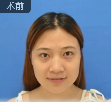 重庆超雅不开刀去眼袋手术好用吗?看她得效果! 重庆超雅不开刀去眼袋手术好用吗?看她得效果!