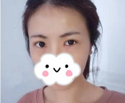 超声波去眼袋让我们再也无惧眼袋这岁月**!184 超声波去眼袋让我们再也无惧眼袋这岁月**!184