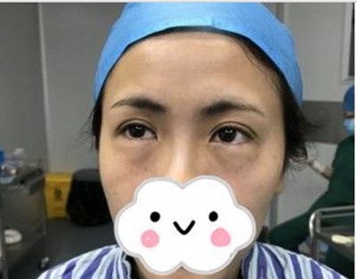 超声波去眼袋让我们再也无惧眼袋这岁月**!184 超声波去眼袋让我们再也无惧眼袋这岁月**!184