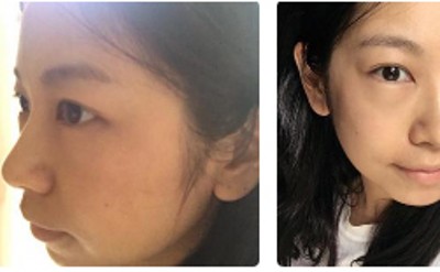 向眼袋患者隆重推荐超声波去眼袋!335 向眼袋患者隆重推荐超声波去眼袋!335