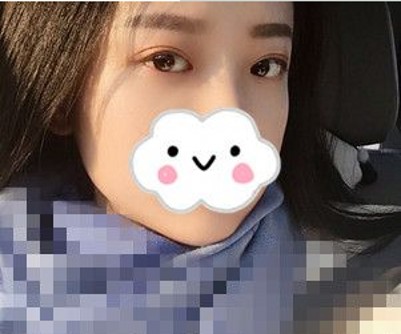 超声波去眼袋帮助闺蜜小莫去了头疼的大眼袋!606 超声波去眼袋帮助闺蜜小莫去了头疼的大眼袋!606