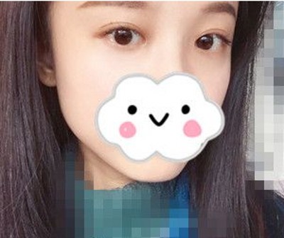 超声波去眼袋帮助闺蜜小莫去了头疼的大眼袋!606 超声波去眼袋帮助闺蜜小莫去了头疼的大眼袋!606