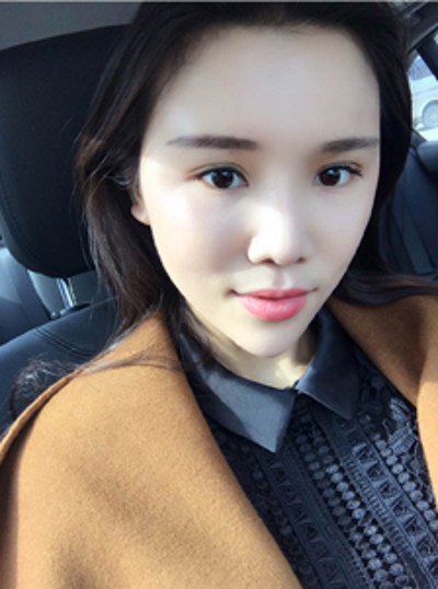 重庆超雅超 声 波去眼袋，美美得化个妆，再也不用遮掩眼袋le
