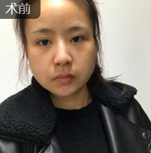 发型室老板来重庆超雅果断寻美,做面部提升术278 发型室老板来重庆超雅果断寻美,做面部提升术278