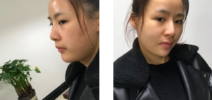 发型室老板来重庆超雅果断寻美,做面部提升术278 发型室老板来重庆超雅果断寻美,做面部提升术278