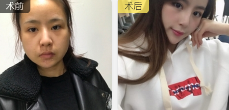 发型室老板来重庆超雅果断寻美,做面部提升术278 发型室老板来重庆超雅果断寻美,做面部提升术278