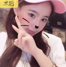 发型室老板来重庆超雅果断寻美,做面部提升术278 发型室老板来重庆超雅果断寻美,做面部提升术278
