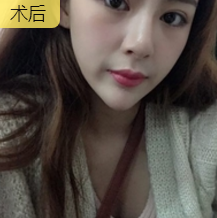 发型室老板来重庆超雅果断寻美,做面部提升术278 发型室老板来重庆超雅果断寻美,做面部提升术278