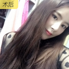 发型室老板来重庆超雅果断寻美,做面部提升术278 发型室老板来重庆超雅果断寻美,做面部提升术278