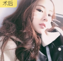 发型室老板来重庆超雅果断寻美,做面部提升术278 发型室老板来重庆超雅果断寻美,做面部提升术278