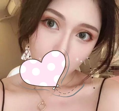 超声波双眼皮,自然流畅得双眼皮408 超声波双眼皮,自然流畅得双眼皮408