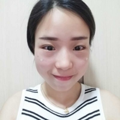 超声波去眼袋,再不被同事误会工作没精神!252 超声波去眼袋,再不被同事误会工作没精神!252