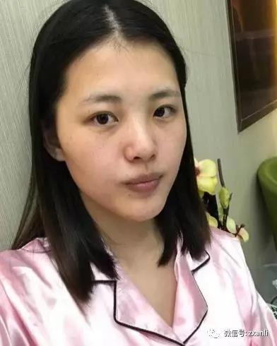超声波双眼皮让我在追求美的路上前进一大步!930 超声波双眼皮让我在追求美的路上前进一大步!930