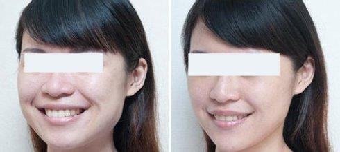 脸大过年也能有惊喜？重庆超雅超 声 波瘦脸在等你！