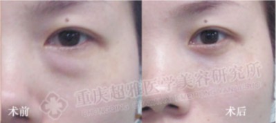 超声波去眼袋成功真实案例分享111 超声波去眼袋成功真实案例分享111