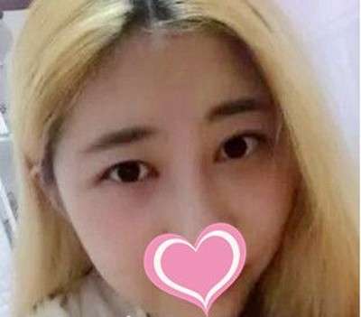 超声波去眼袋让时光驻足留住美!391 超声波去眼袋让时光驻足留住美!391